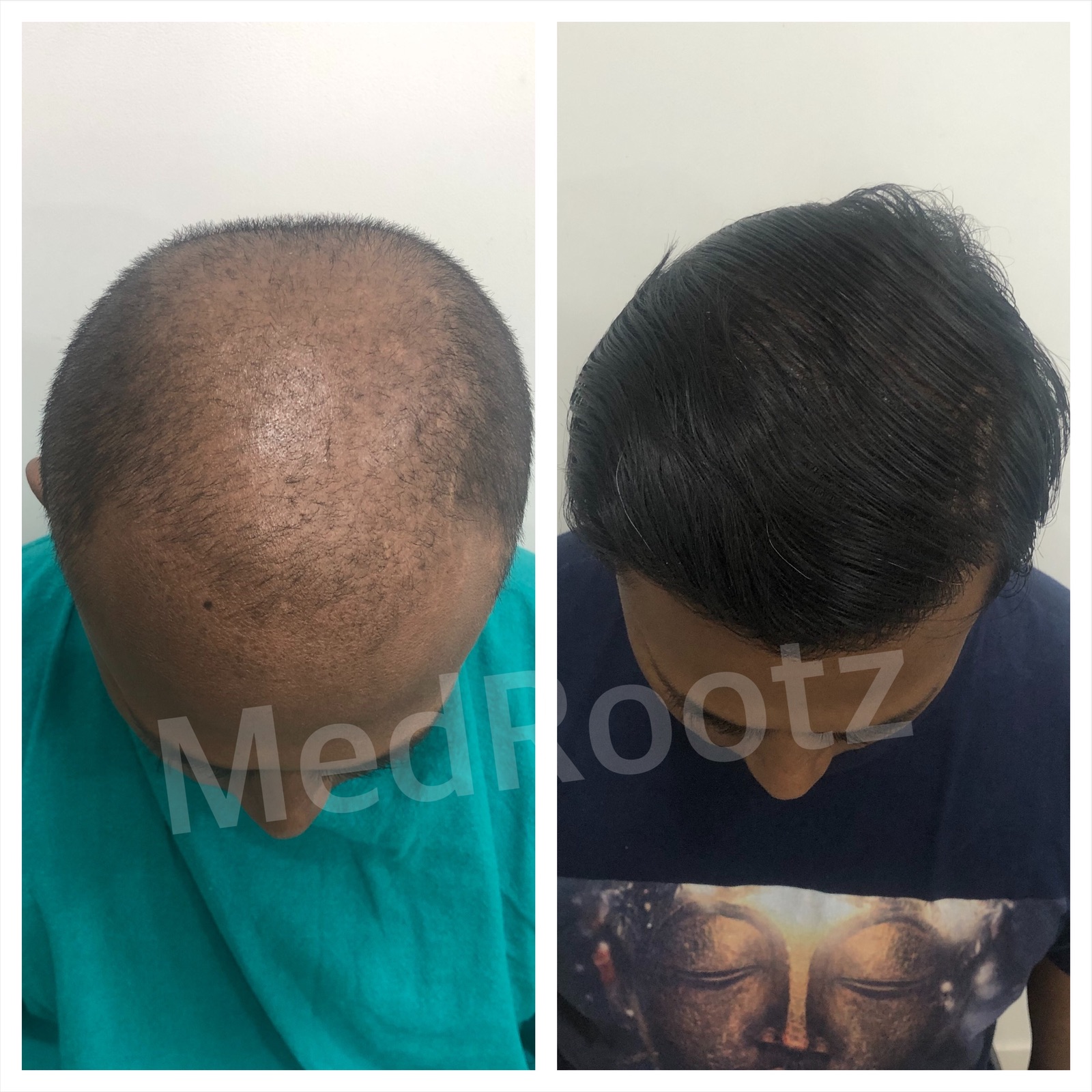 Best Hair Transplant clinic in delhi